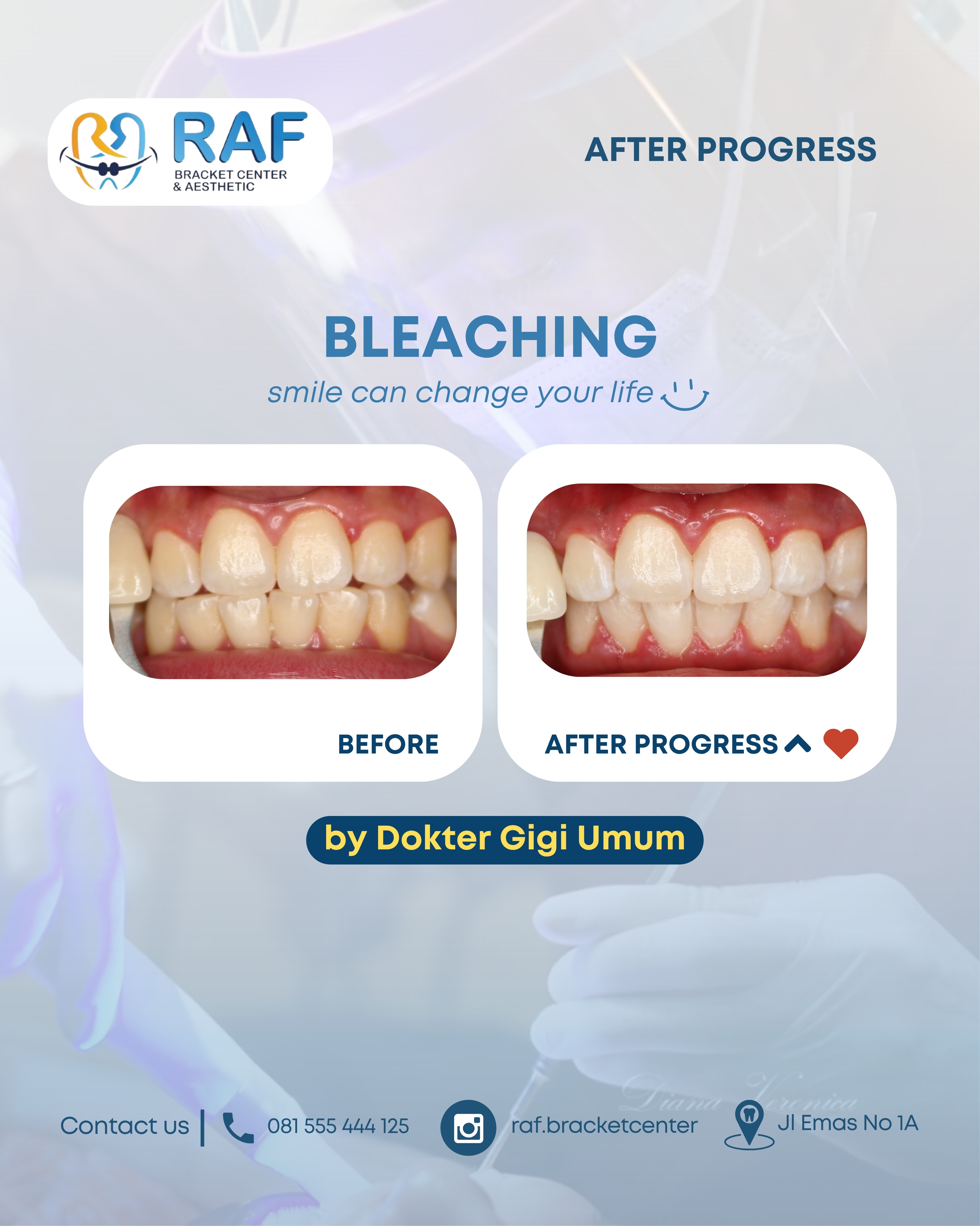 Bleaching