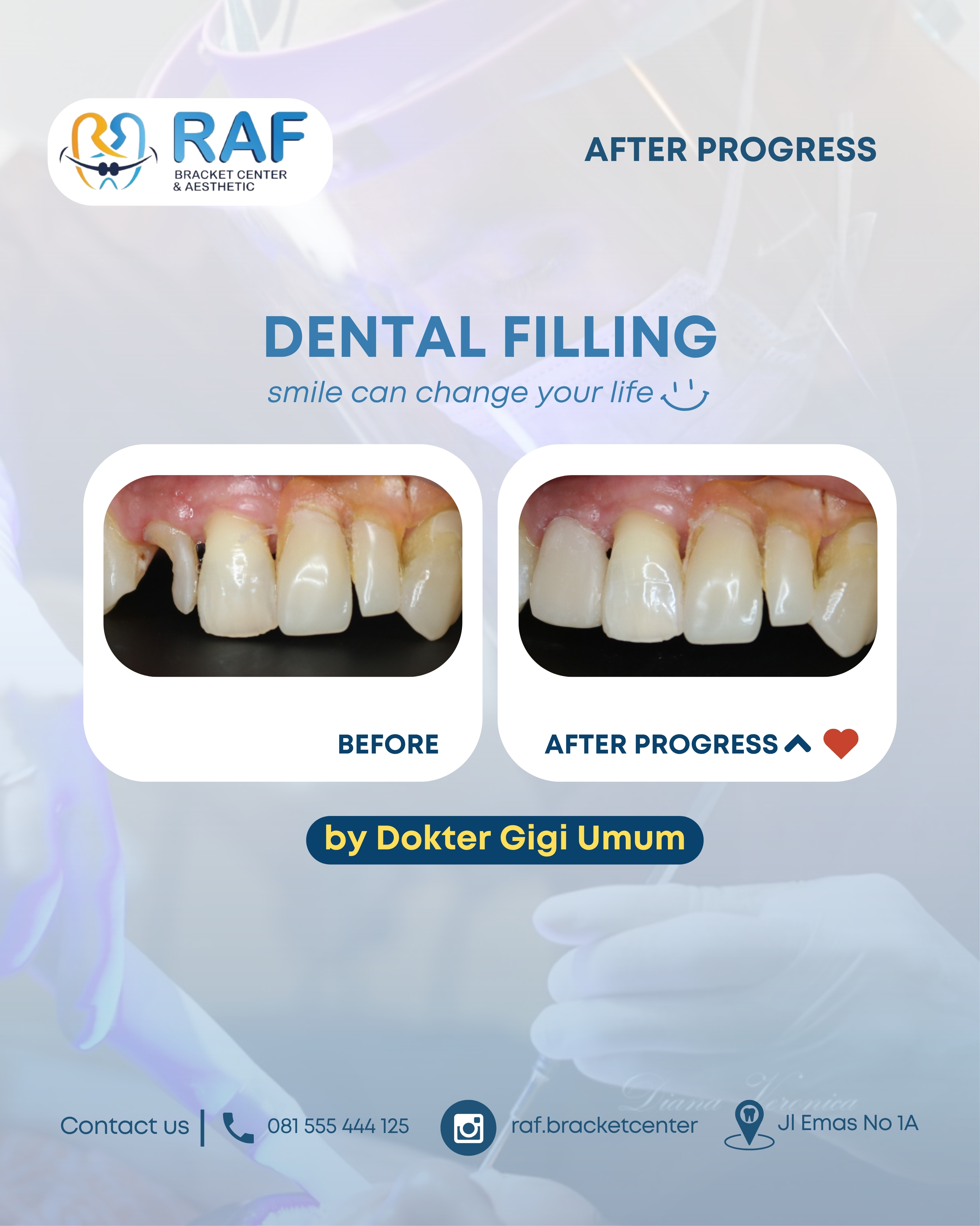 Dental Filling