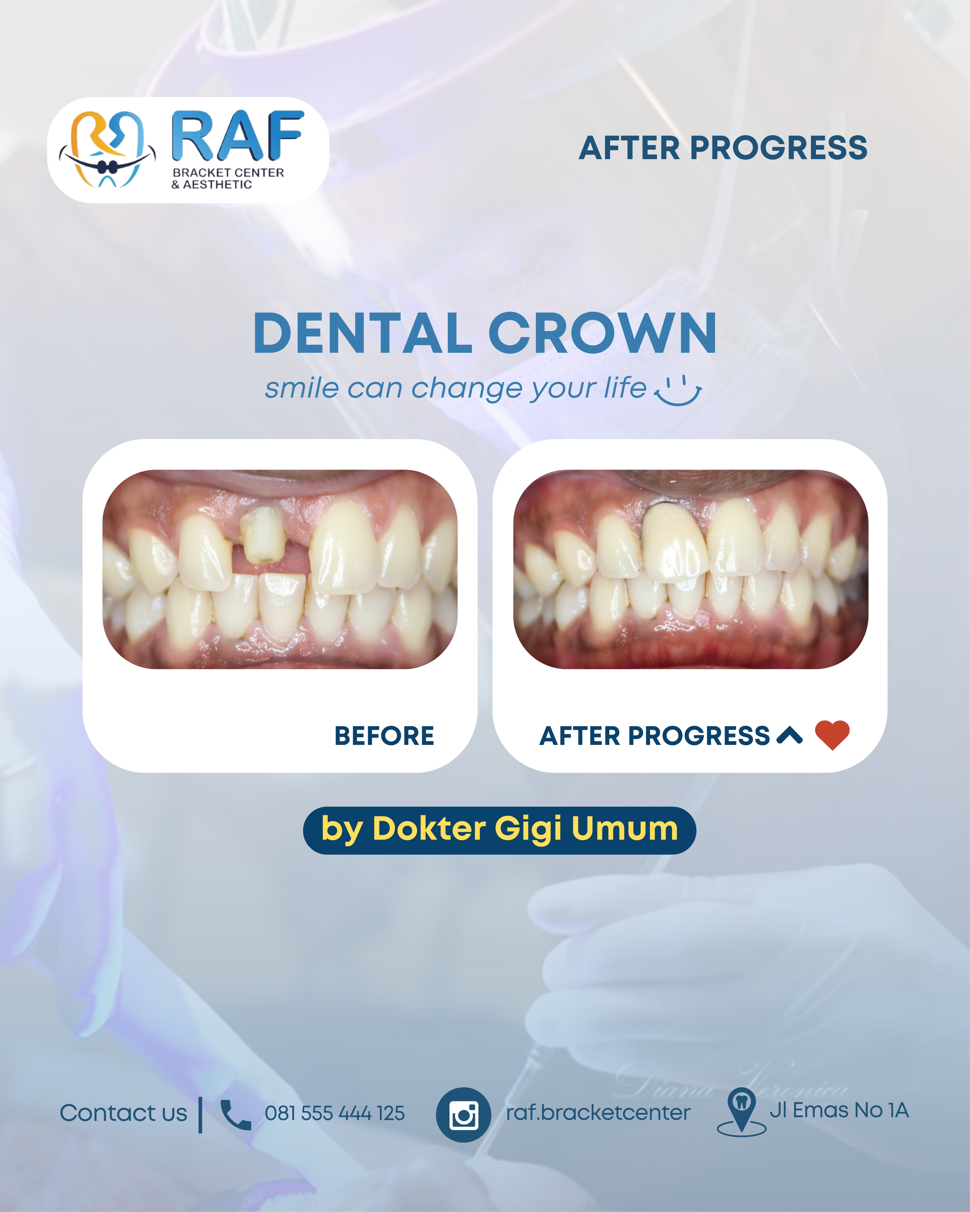 Dental Crown