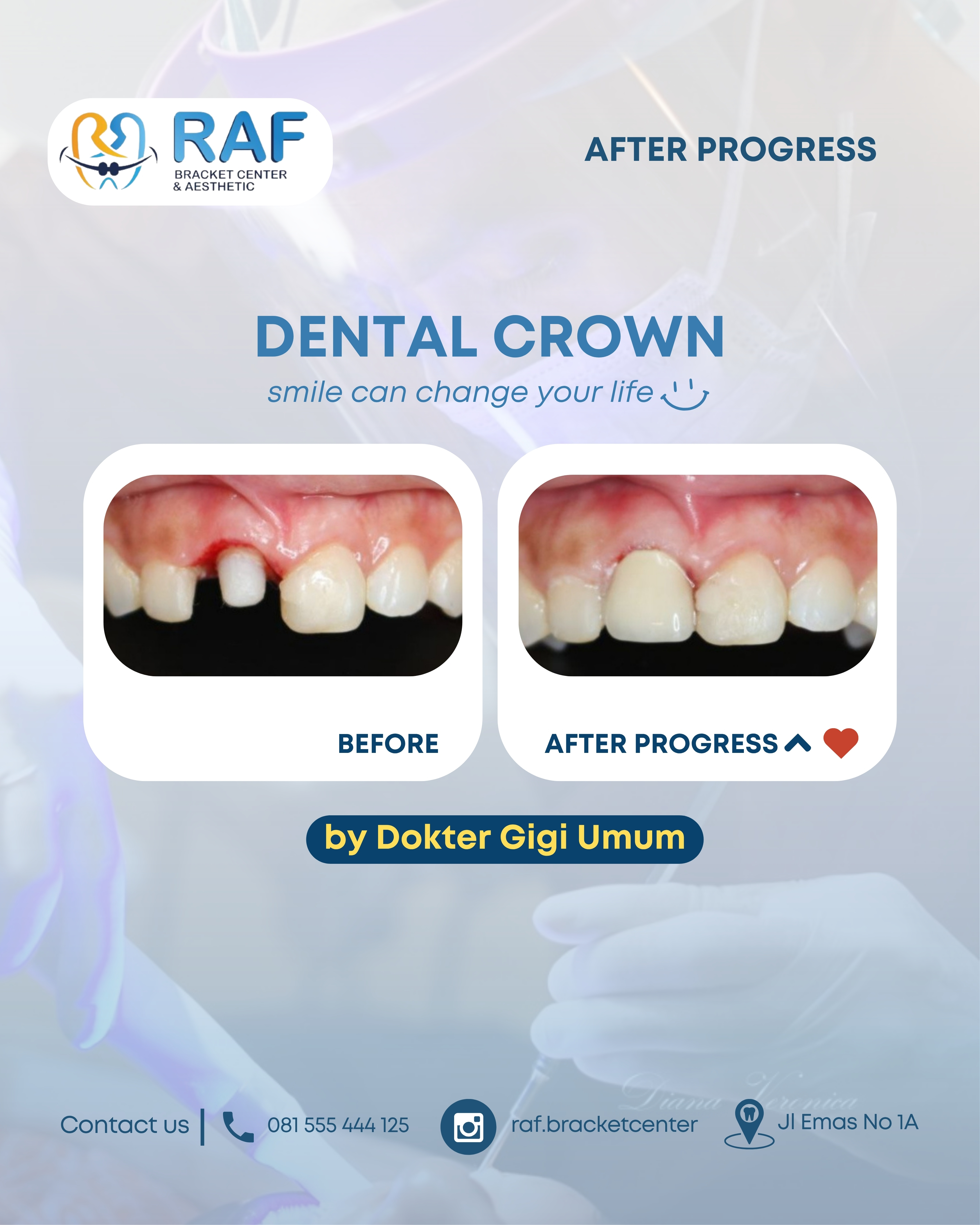 Dental Crown