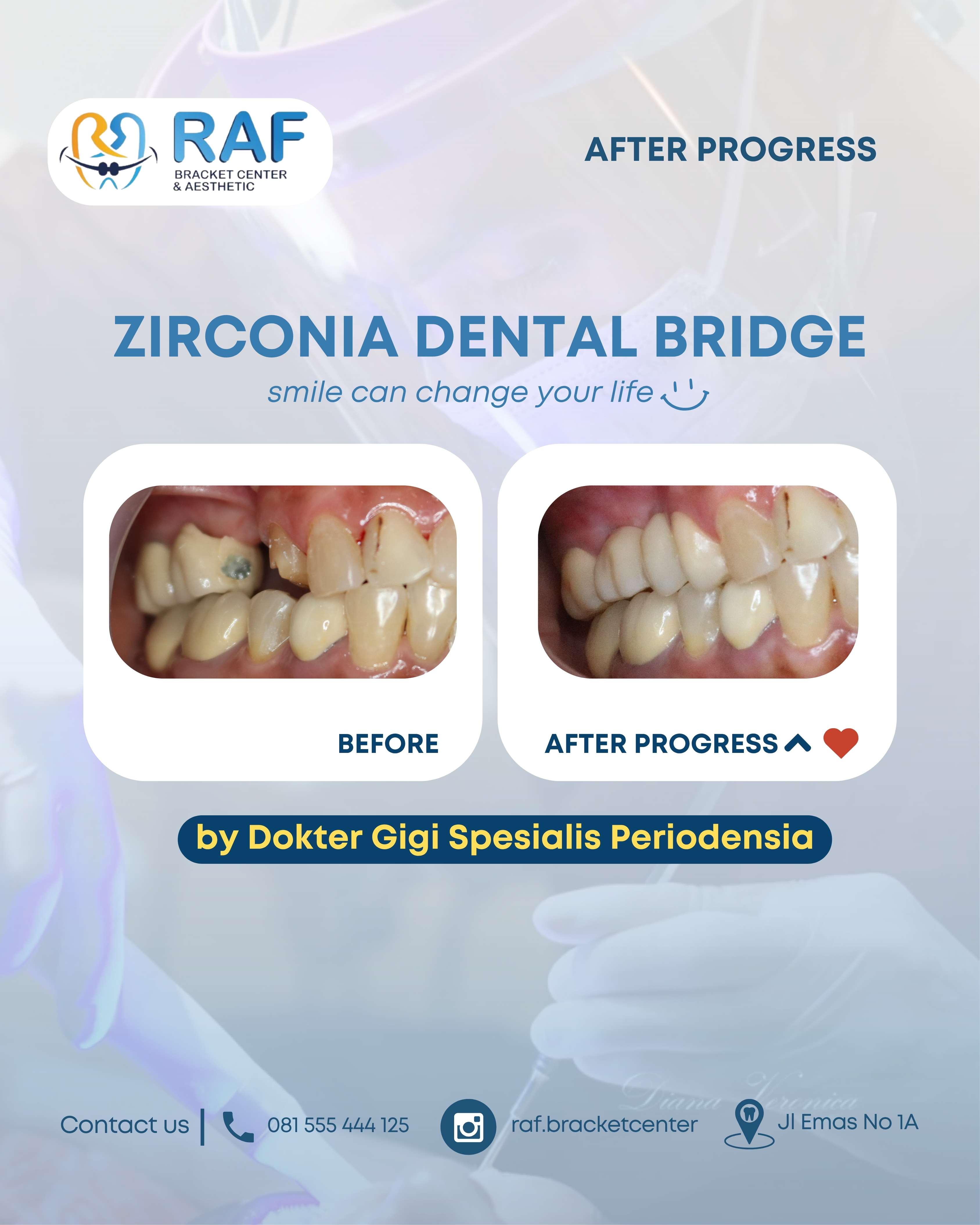Zirconia Dental Bridge