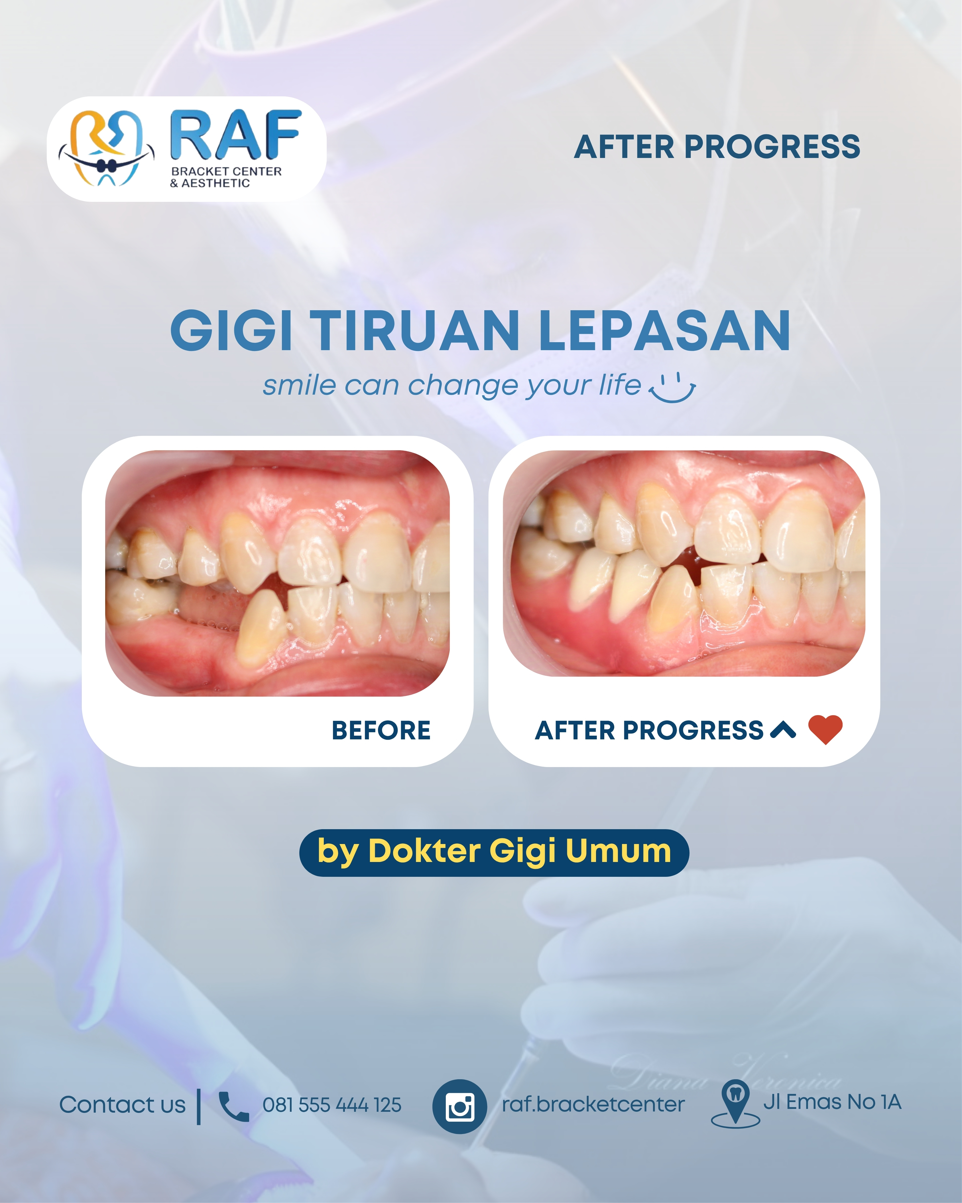 Gigi Tiruan Lepasan