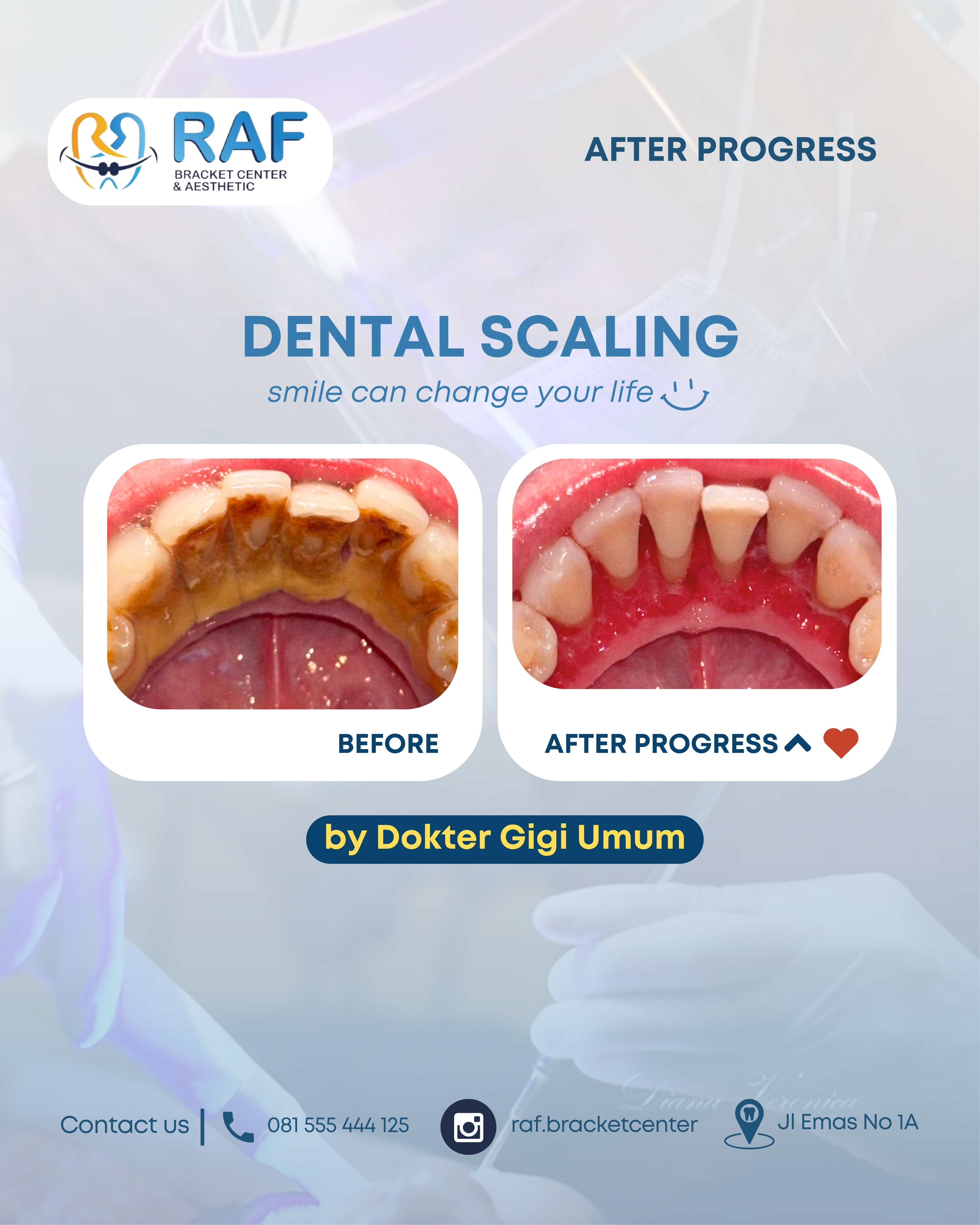 Dental Scaling