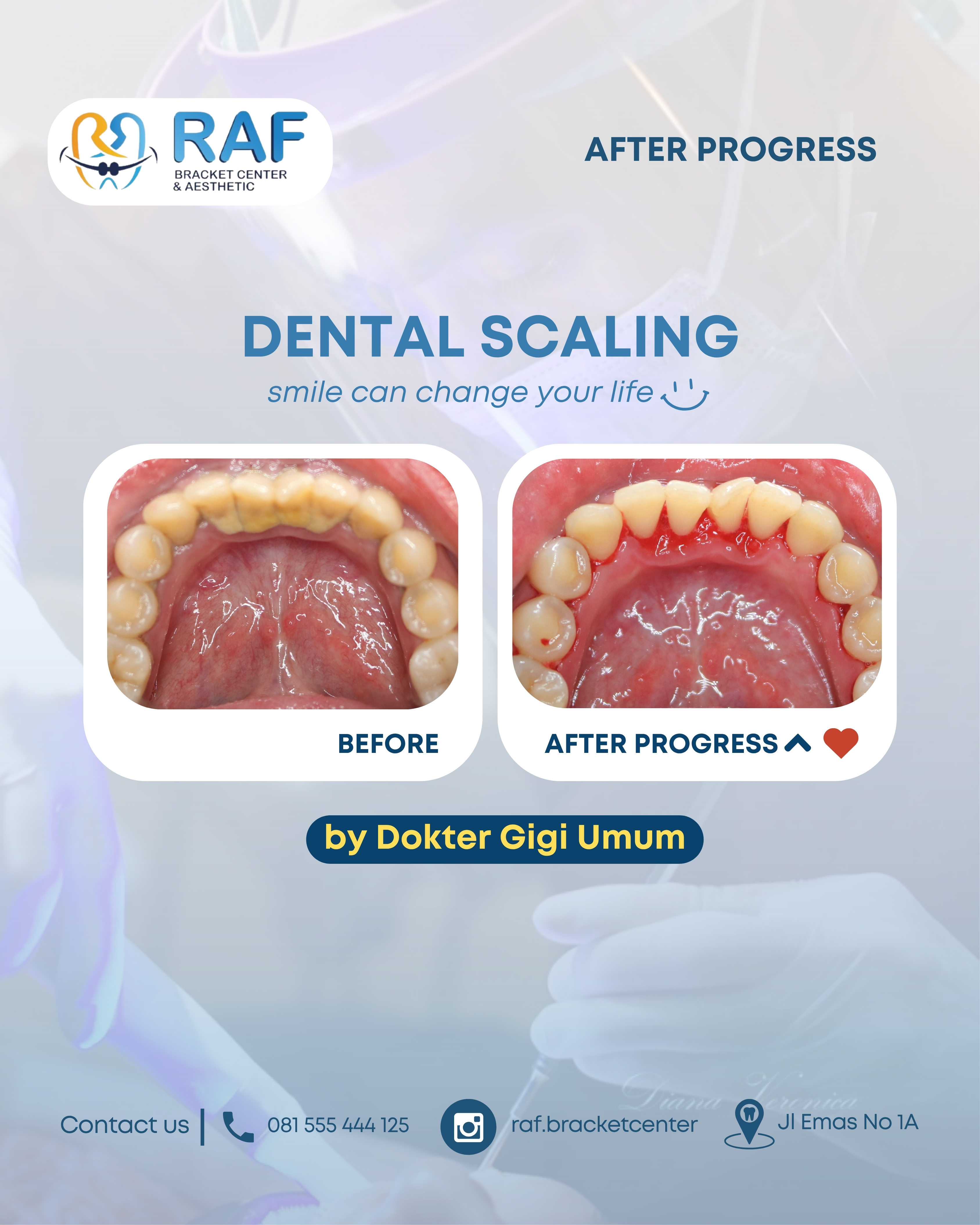Dental Scaling