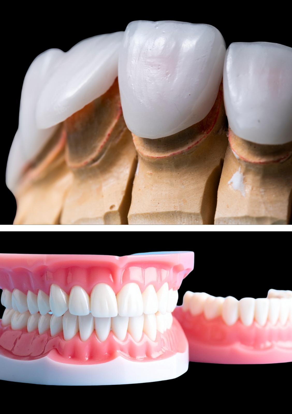 Gigi Tiruan dan Veneer